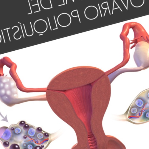 Síndrome de Ovario Poliquístico: trátalo de manera natural
